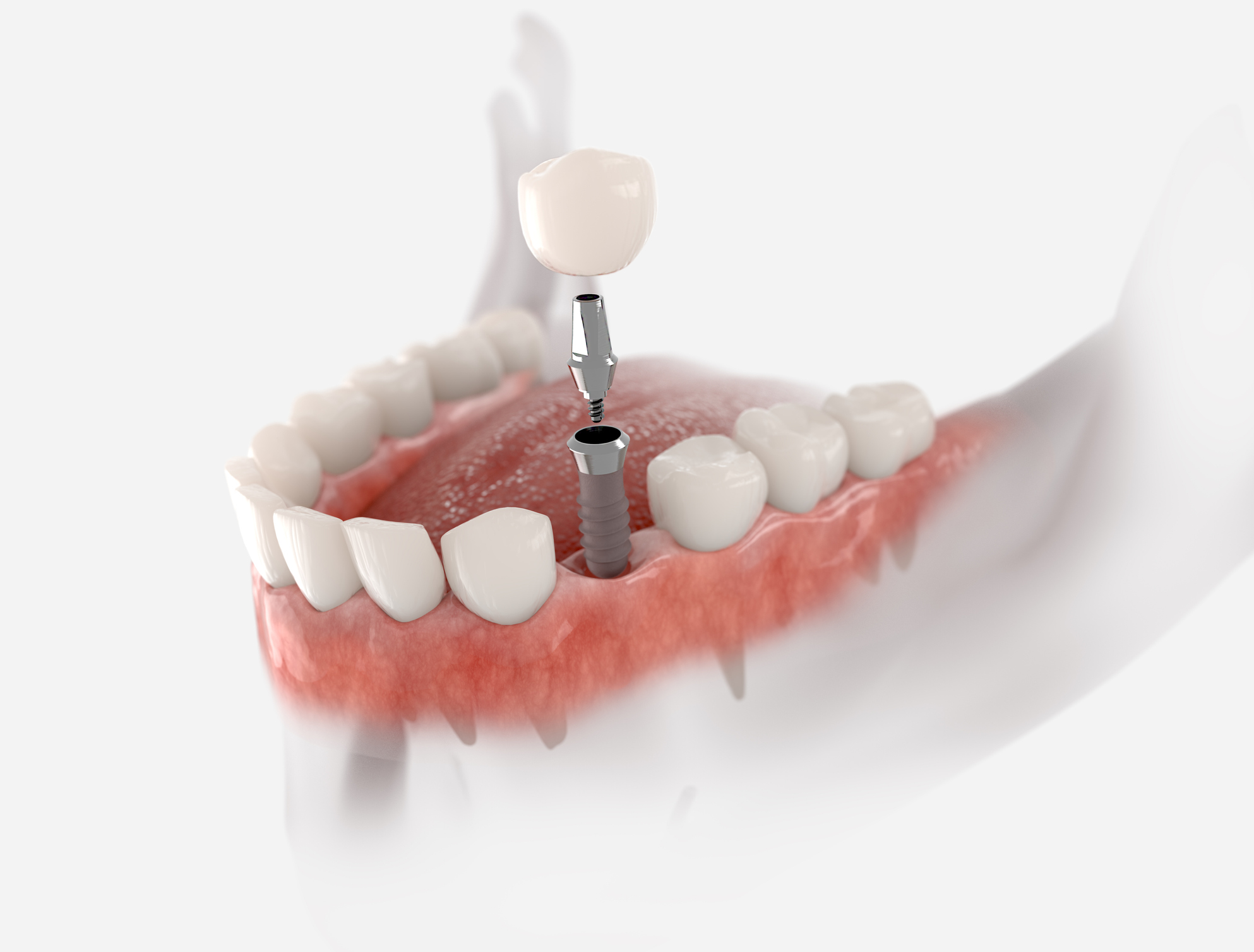 5 Common Myths About Dental Implants