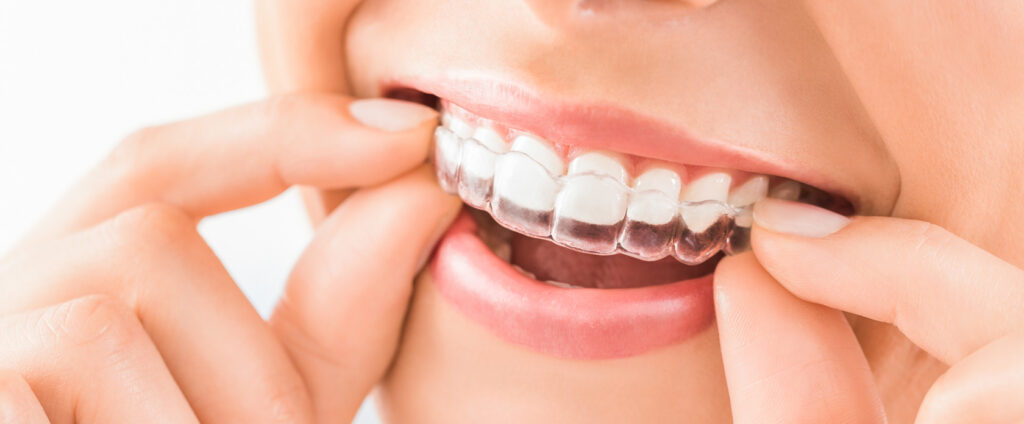 invisalign boca raton